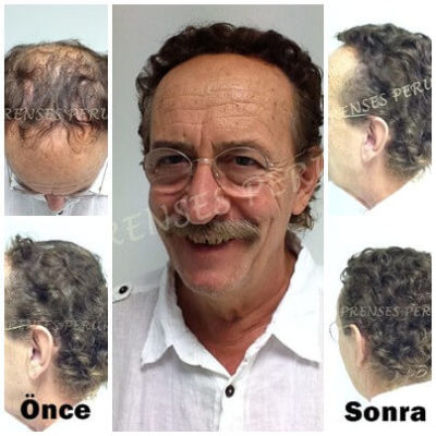 Protez Saç - 1