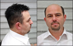 Protez Saç Toupe %100 Doğal Görüntü - 5